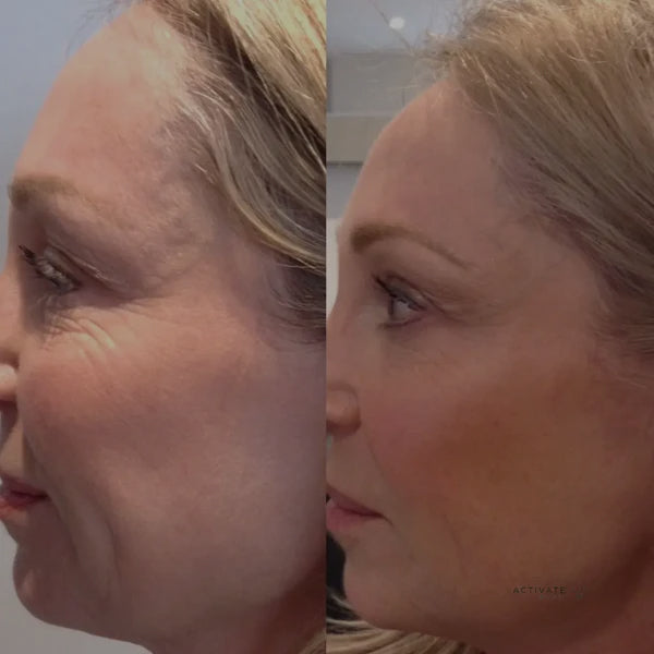 Bioremodeling Skin Booster Profhilo